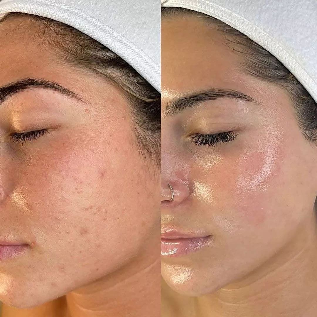 OxyJet Facial before and after — real SkinX Spa client in Ajax, Ontario