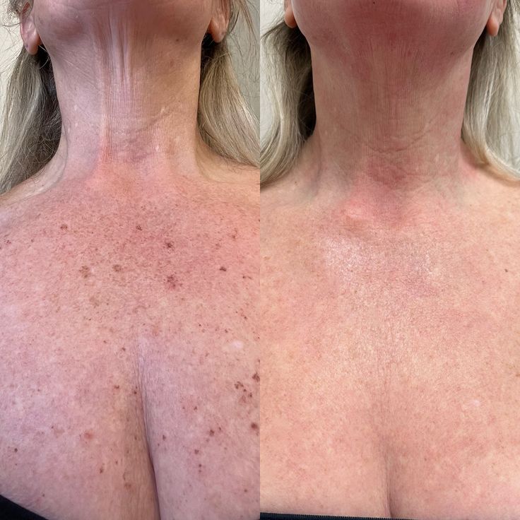 Skin rejuvenation before and after — Chest & décolletage — real SKINX SPA client, Ajax