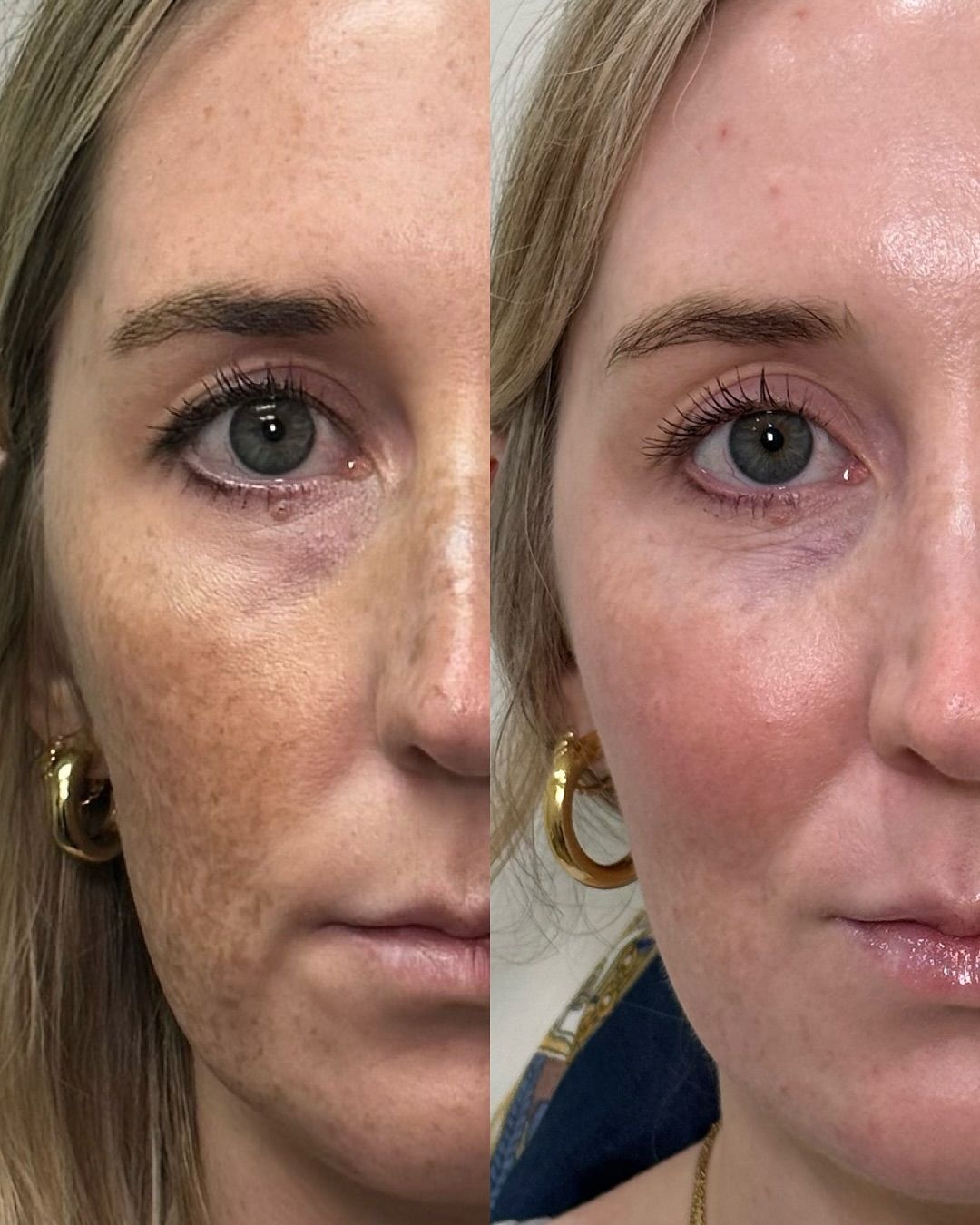 Skin rejuvenation before and after — Sun damage & freckles — real SKINX SPA client, Ajax
