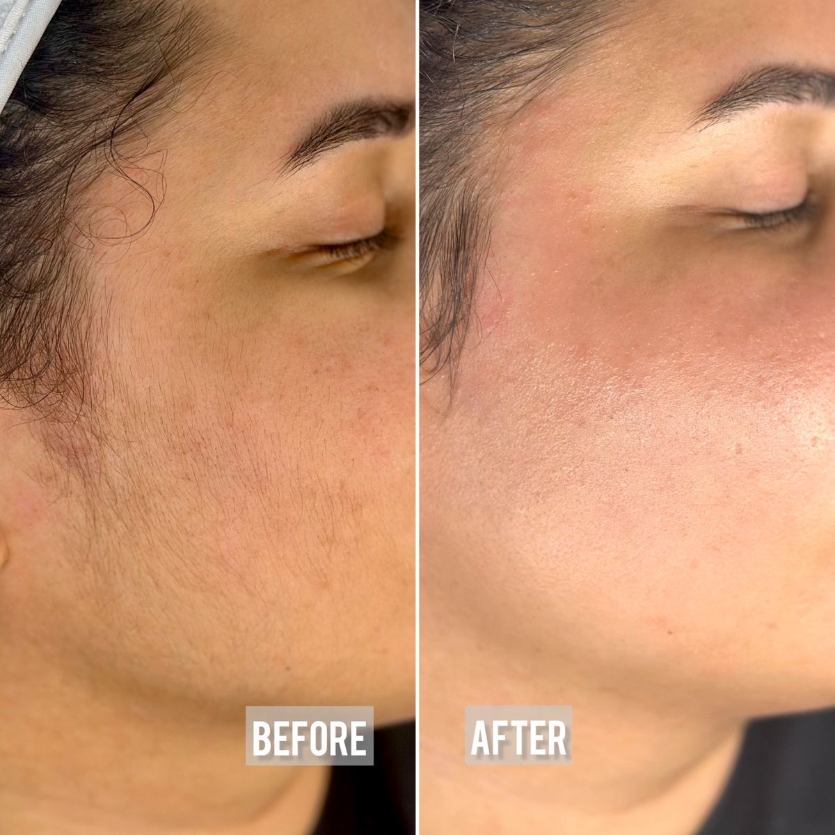 Laser hair removal before and after — Facial hair — real SKINX SPA client, Ajax