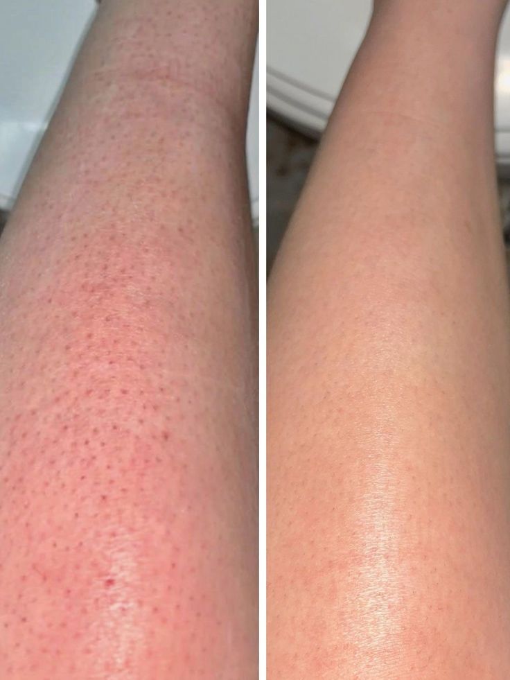Laser hair removal before and after — Legs — real SKINX SPA client, Ajax