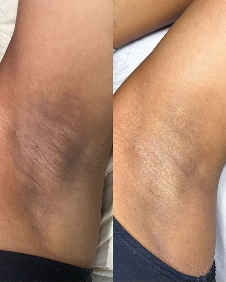 Laser hair removal before and after — Underarms — real SKINX SPA client, Ajax